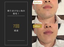 ステイゴールド 新百合ヶ丘(STAY GOLD)/おヒゲ脱毛の経過☆