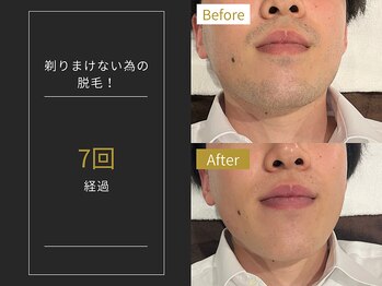 ステイゴールド 新百合ヶ丘(STAY GOLD)/おヒゲ脱毛の経過☆