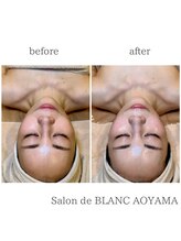 サロン ド ブラン アオヤマ(Salon de BLANC AOYAMA)/BLANC式小顔60分コース