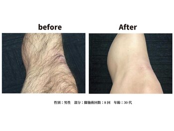 サロン ニヒル(SALON NIHIL)/◇脚脱毛◇