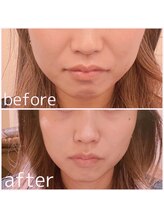 モアビューティー 紙屋町店/【ダウンタイム無し！】