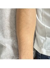 カルム(calm.)/メンズ腕シュガーリング脱毛前