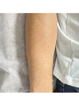 カルム(calm.)/メンズ腕シュガーリング脱毛前