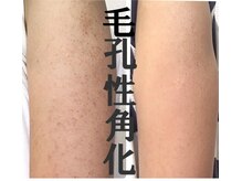 フロージア 新宿南口店(FLOGIEIA)の雰囲気（背中・二の腕・お尻のハーブピーリングも人気／ハーブピーリング）