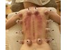 【全身】【吸玉カッピング＆脂肪燃焼】漢方アロマ＆スーパーデトックスコース