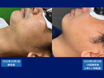 父さん専用ヒゲ脱毛の店/脱毛比較写真　＃天王寺脱毛