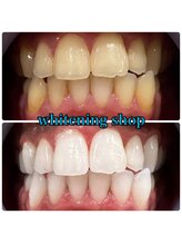 ホワイトニングショップ 大阪玉造店/Before&After美白ホワイトニング