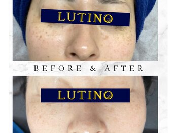 ルチノ(LUTINO)/シミケアプラズマ