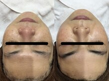 ナガイ美容/カーボンVIPコース施術例