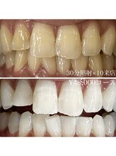 ホワイトニングルーム 川崎店(WhiteningRoom)/ホワイトニング/川崎