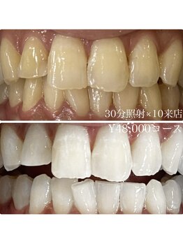 ホワイトニングルーム 川崎店(WhiteningRoom)/ホワイトニング/川崎