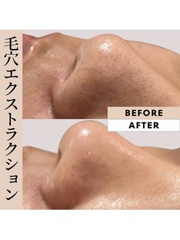 ラウレア(Laule'A)/毛穴エクストラクション