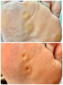 ラヴィ(La vie)/魚の目ができて痛み