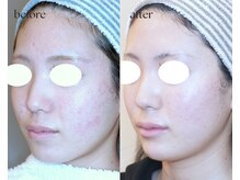 岩川治療院/ニキビによる赤みの減少♪