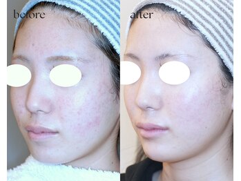 岩川治療院/ニキビによる赤みの減少♪