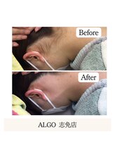 アルゴ 志免店(ALGO)/毛穴洗浄と幹細胞導入！