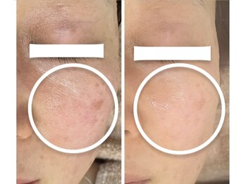 エステサロンパリス(Esthe Salon Paris)/シミくすみだけでなく肌質も変化