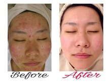 ハイケア グラン ギンザ(HYCARE GRAND GINZA)/日本ーの肌改善サロン実力/銀座