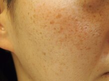 エステティックガーデン小町ストーリー/シミ改善【ビフォー】