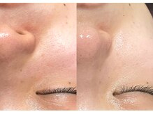 ダリア(DAHLIA)/開き毛穴/REVIハーブピーリング