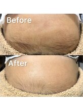 サーティースリー 横浜元町(Thirty3)/【脱毛】Before/After