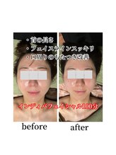 スマイルミー/術後　before-after
