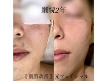 ウイ(u’i)/【人気】肌質改善！