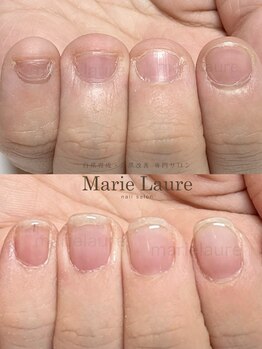 マリーロール 梅田店(Marie Laure)/自爪育成/深爪矯正/ネイルケア