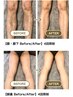【メンズ×ご新規】下半身ぜーんぶ脱毛！両脚丸ごと＋VIOセット　15000円