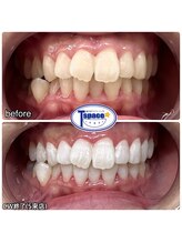 ティースペース 蒲郡店(T-space)/クリスタルWhite plus