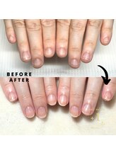 プラスワン(+1)/ハンド深爪矯正