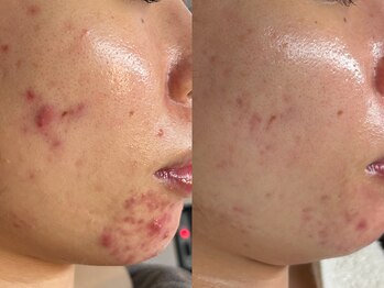 プレナ(PLENA)/【繰り返しニキビケア】