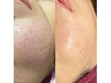 深いお悩みにはハーブ×プラズマの組み合わせがオススメ！