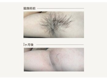 クレビア(CREVIA)/メンズわき脱毛◆BeforeAfter