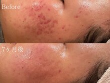 ポポラス(POPOLUS)/ニキビケア7ヶ月