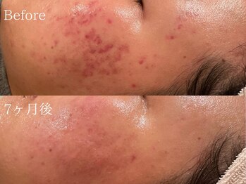 ポポラス(POPOLUS)/ニキビケア7ヶ月