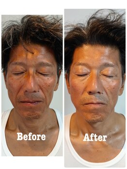 エヌプラスビューティー(N+beauty)/メンズはフェイシャルのみ可能！
