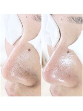 ニュートラル(neutral)/毛穴エクストラクションプロ大分