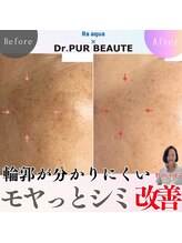エステティックサロン ラ アクア(ra aqua)/モヤっとシミもDrピュールボーテ