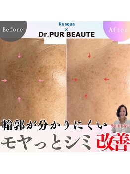 エステティックサロン ラ アクア(ra aqua)/モヤっとシミもDrピュールボーテ