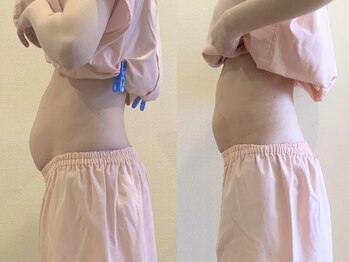 アカシア鍼灸整骨院の写真/道内初！脂肪を直接アプローチする【痩身鍼灸】圧倒的変化を実感★ウエスト最大マイナス13センチ減◎