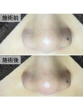 美鼻ラボ 押上 曳舟/黒ずみ毛穴放っておかないで！