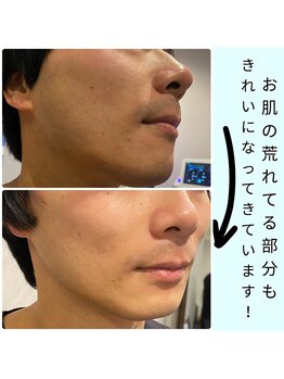 ワイズサロン(Y's salon)/美肌ジェル脱毛で肌荒れも改善！