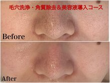 ビジュラン グロスキングツヤ王(Bijuran GlossKingツヤ王)/毛穴洗浄・美容液導入１回の変化