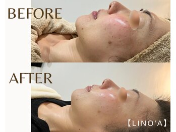リノア 柏(Lino'a)/フェイシャル｜小顔リフティング