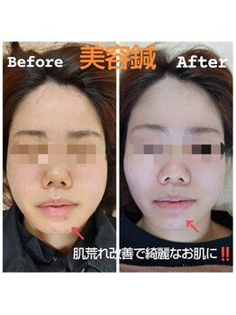 美藤鍼灸院/美容鍼で肌荒れ改善して美肌に