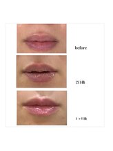 リリーガーデン 手稲店(Lily Garden)/before after【ローマピンク】