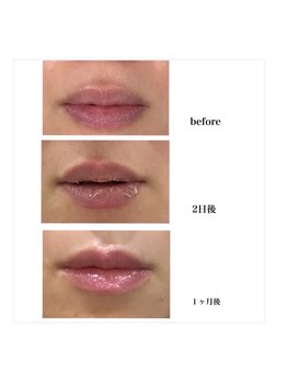 リリーガーデン 手稲店(Lily Garden)/before after【ローマピンク】