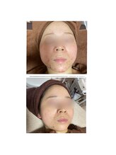 トータルビューティーサロン ヴィヴィエ(ViVier)/ララピール×ニキビ