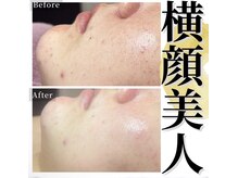 癒える(ielu)/次世代ハーブピーリング★顔